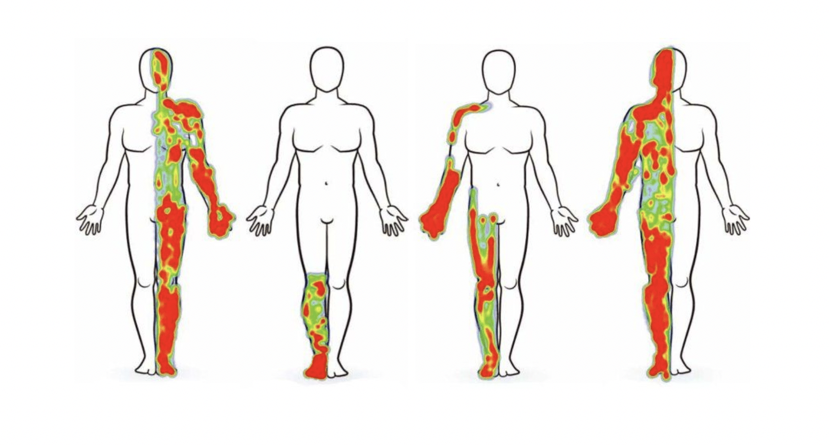 Chronic Pain Linked to Brain Signals in Orbitofrontal Cortex - The