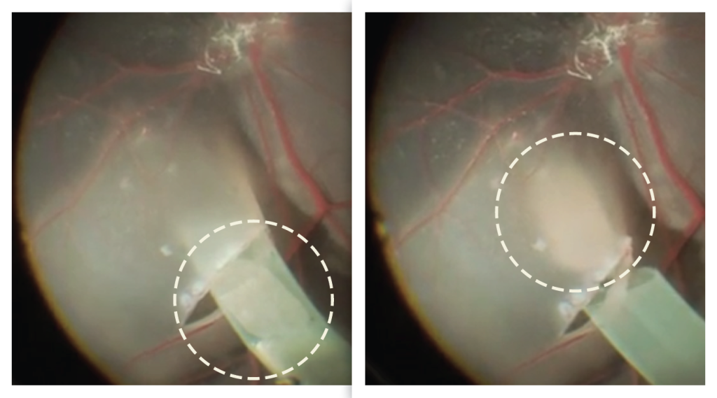 Inside NYSCF's Cell Therapy for Macular Degeneration - New York Stem ...